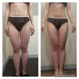 モデル様募集🌿全身痩身ハイパーナイフ✖️強力デトックスマッサージ🔥