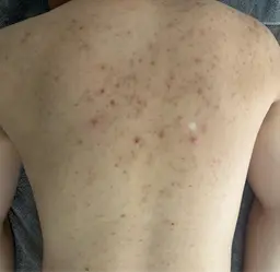 第一印象はお肌で決まる！！メンズにも大人気ハーブピーリング