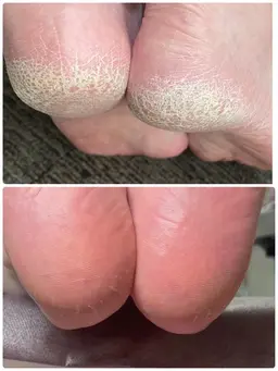 (土日祝)フットバス・爪切り・爪周り＆角質ケア・たこ＆魚の目ケア・巻き爪ケア (ジェル・ポリッシュなし)