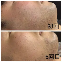【初回限定💎】朝がラクになる✨メンズヒゲ脱毛