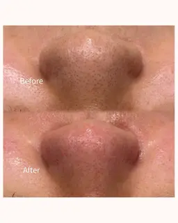 【スッキリ綺麗🫧】鼻のみ毛穴洗浄👃🏻✨