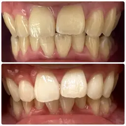 初回ナチュラルホワイトニング(美容ホワイトニング)