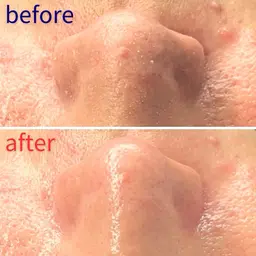 【角栓汚れゴッソリ!】毛穴洗浄(顔全体〜首)+エレクトロポレーション幹細胞美容液導入