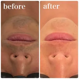 当日限定ゲリラクーポン【ELIXIR男性人気No.1✨】ヒゲ脱毛🐾⚠️当日予約限定500円にて！⚠️