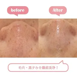 ざらつき・毛穴汚れ解消コース