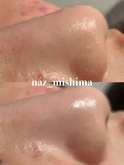 【📸写真モデル】毛穴洗浄の Before/After撮影にご協力いただける方を募集しています！