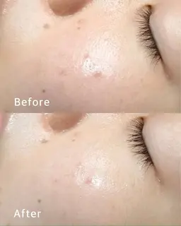 🍀平日限定🍀足ツボ👣5分付き🌟シミ・くすみ・毛穴悩みに❣️生コラフェイシャル🌟