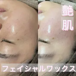 フェイシャルワックス+鎮静パック🚹🚺