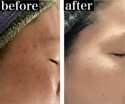 【毛穴・くすみ・肌荒れ改善】初回体験★透明感UPへ