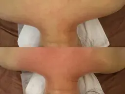 上半身集中ハイパーナイフ+リンパ40分