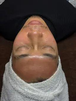 【ハリツヤ】水分爆弾✨スーパージェクションヒアルロン酸フェイシャル（ナノチップ導入）