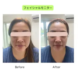 植物性ミネラルで整える小顔フェイシャル＋快楽ヘッドスパ:モニター