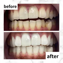 【👑人気No.1👑】5分照射×2回✨照射パワー2倍の最新高速セルフホワイトニングで時短ホワイトニング🦷❣