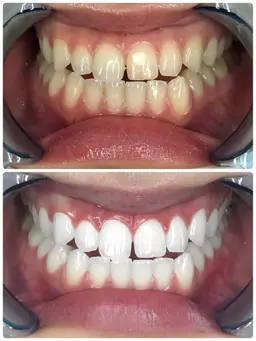 【輝く白さ】ダブルプレミアムセルフホワイトニング合計160分4来店