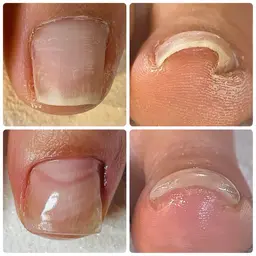 無料モデル募集！巻き爪、変形爪、肥厚爪、タコ、魚の目4月17日、24日限定