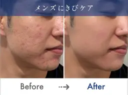 ✨モニター価格得✨【ニキビ/ニキビ跡/毛穴】ハーブピーリング🌿