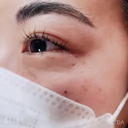 アイラッシュリフト+アイブロウリフト