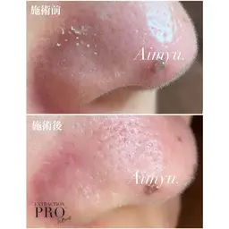 新年特別企画🎁人気No.1👑【毛穴美人コース】🫧70分を特別価格で💓