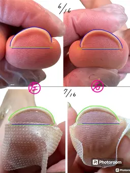【巻き爪モデル】巻き爪施術
