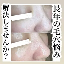 毛穴エクストラクションで長年の悩みを解消しませんか？