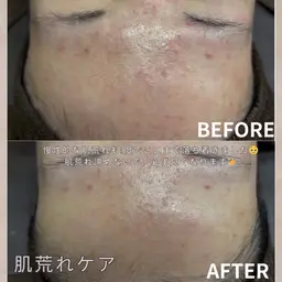 【ニキビ肌から艶肌に✨】お試しダウンタイム痛みなし✖️ニキビ跡や軽度のクレーターにも◎幹細胞ハーブピーリング🌿90分