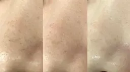 毛穴洗浄美肌＋小顔コース