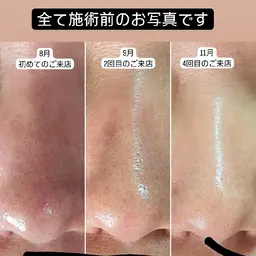 【平日割引】限定価格の毛穴洗浄‼️