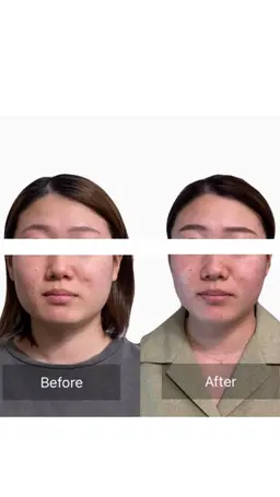 【小顔結果重視】美容鍼×小顔矯正×首肩こりマッサージ　¥15,000→¥9,980