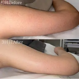 【二の腕のぶつぶつ】ハーブピーリング/陶肌トリートメント ※Before/Afterのお写真、口コミにご協力いただける方