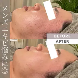 【メンズニキビケア⭐️】剥離なし/REVIハーブピーリングでニキビケア🌿デコルテマッサージ付き 通常¥11,000