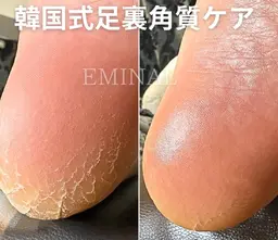 韓国式足裏角質ケア