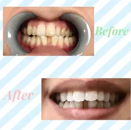 【ミニモ新規限定】メディアで話題✨セルフホワイトニング通常コース8分x2 【すぐ予約対象外】