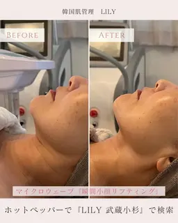 大人気！エステ版オンダリフト×AHAハーブピーリング　¥36000→