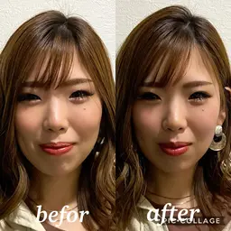 小顔ソムリエ®︎による小顔矯正＋お顔の筋トレ美容鍼