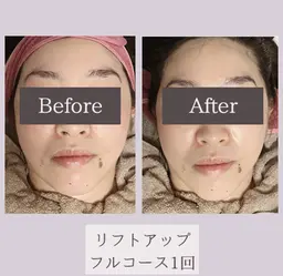 リフトアップフルコース❣️話題のサーマトリックスの効果をぜひお試し下さい🌟