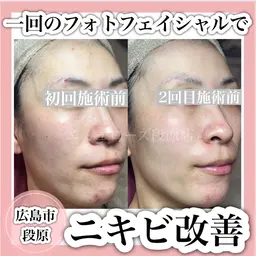 《凸凹肌・毛穴の開き・ニキビケアでお悩みの方》光フェイシャル