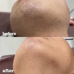 【11月限定価格】メンズヒゲスペシャル脱毛¥6500→¥4000