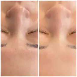 毛穴黒ずみ×くすみにサヨナラ👋　パッと明るくフィルター素肌🫧【次世代🫶毛穴ケア✖️美白ケア】60分