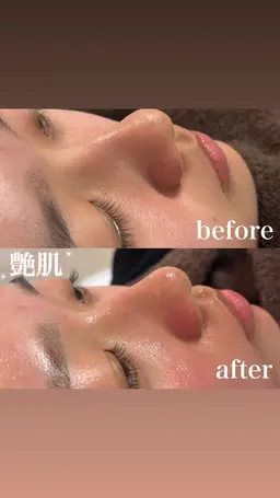 ✨【毛穴ごっそり×ツヤ爆誕】✨フェイシャルワックス × ハイドラフェイシャル