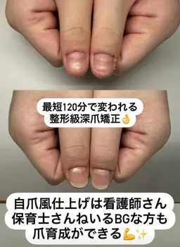 【新規様限定】ハンド深爪矯正/周りにバレずに深爪矯正〜まるで自爪が伸びたような自然な仕上がりで長さ出し