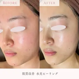 【毎月先着3名様限定！】内側から輝く水光肌になりたい方へ💎うるツヤ水光肌コース マッサージ付70分