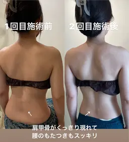 背中が変わるとスルスル痩せる背中深層リンパマッサージ。背中痩せ二の腕痩せ　変化が凄い！ブライダルエステ