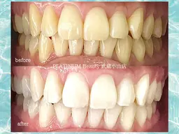 minimo限定【ナチュラルセルフホワイトニング】 トーンUP！25分照射！初回限定！