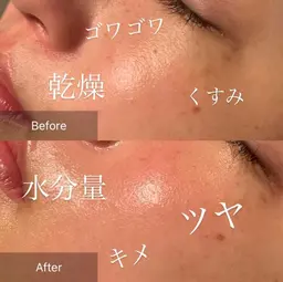 【💎潤 艶美肌💎】ラジオ波×ヒト幹細胞培養液×毛穴洗浄フルコース✨たるみ/毛穴汚れ/黒ずみ/シワ/くすみ/ニキビケア