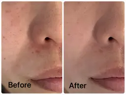 【NEWメニュー】ソフトピーリングで透明感トーンUP➕角質ケア😊