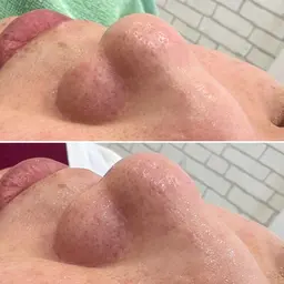 🕊毛穴ケア🌿