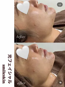 光フェイシャルトリートメント