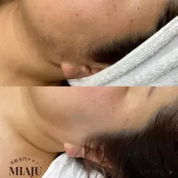 お顔のワックス脱毛+お仕上げ