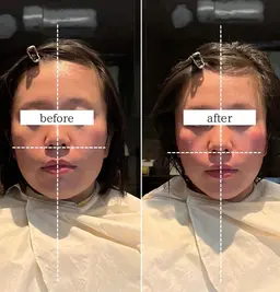 小顔矯正