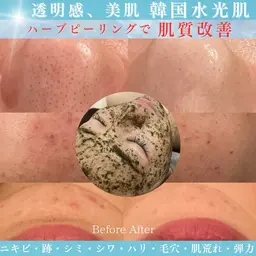 肌質改善🌿​〜​水光肌へ​〜​剥離なし幹細胞ハーブピーリング60分